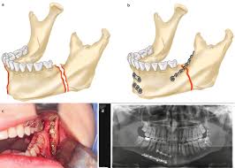 Advanced OPG Scan - Detect Dental Issues Efficiently